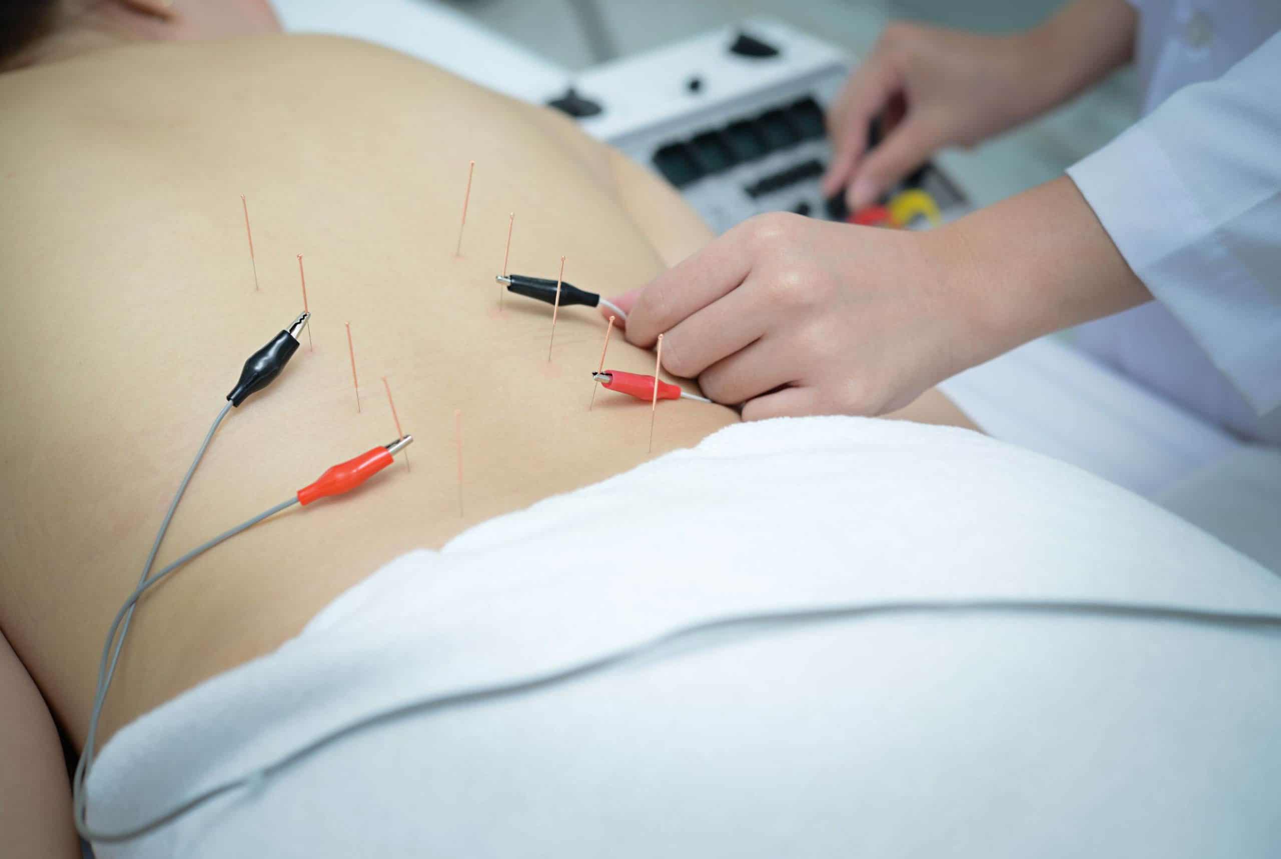 myotherapty patient with needles and eletrical charges in back